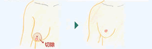 乳房挙上