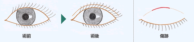 小切開図