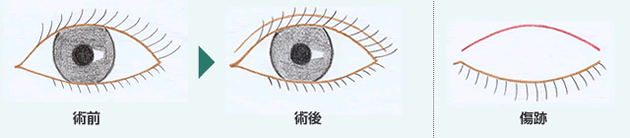 上眼瞼切開（全切開）図
