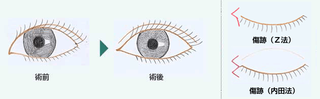 目頭切開