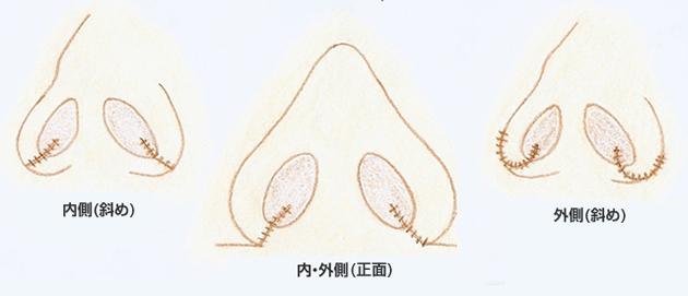 鼻翼縮小図