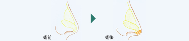 鼻先吊り下げ(耳介軟骨移植法)