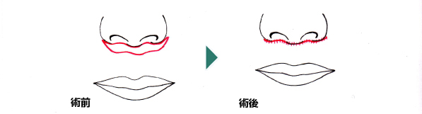 鼻下(人中)短縮