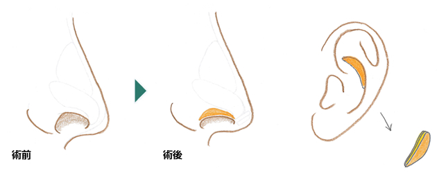 鼻孔縁形成