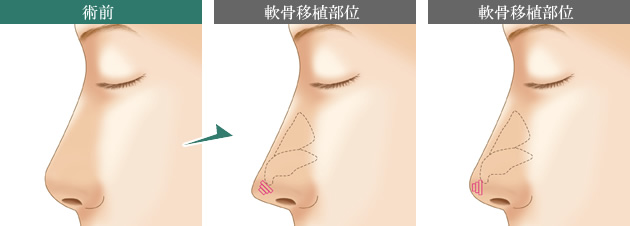 鼻尖延長（耳介軟骨移植）