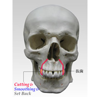 上顎歯槽骨形成(出っ歯)