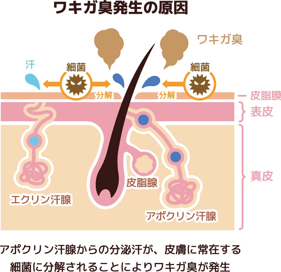福岡のワキガ・多汗症の腋臭発生の原因