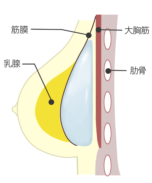 豊胸・バストアップの乳腺下法2