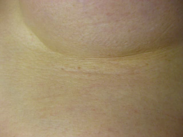 豊胸・バストアップの乳腺下法の切開術後