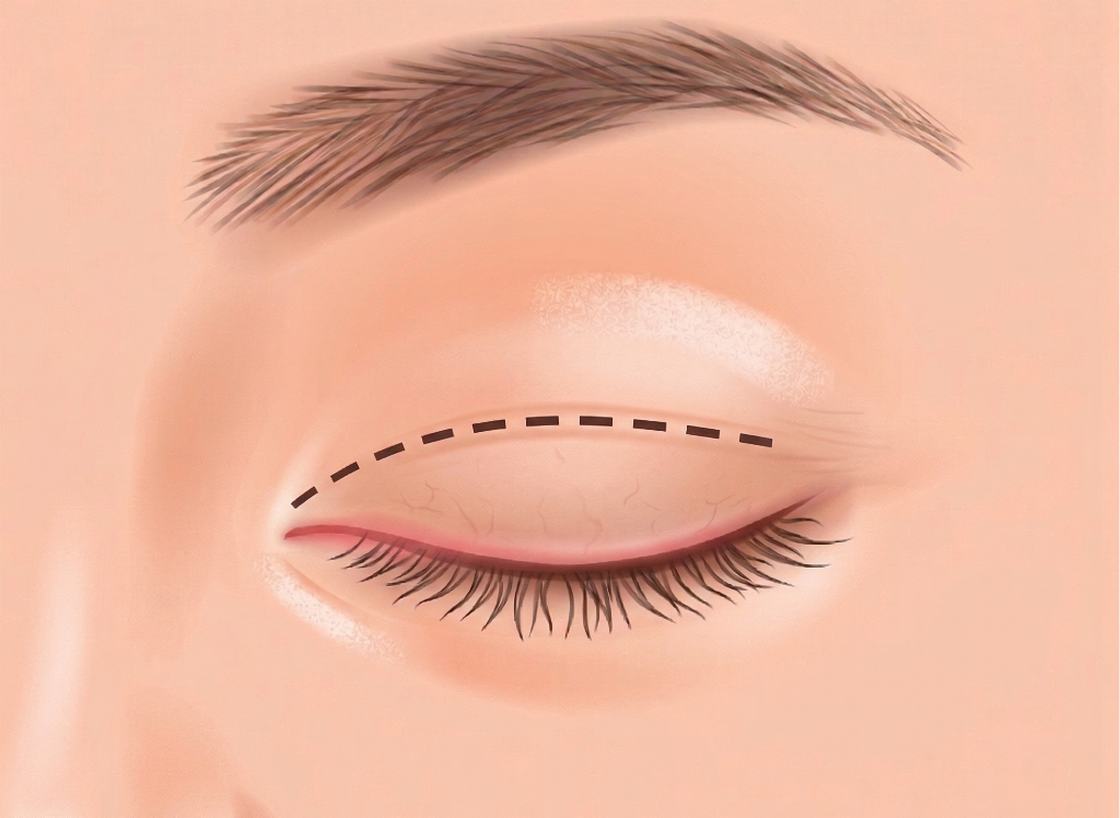 福岡の二重整形の全切開