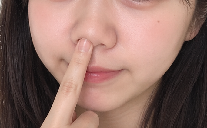 福岡の団子鼻治療「鼻尖縮小」の術式