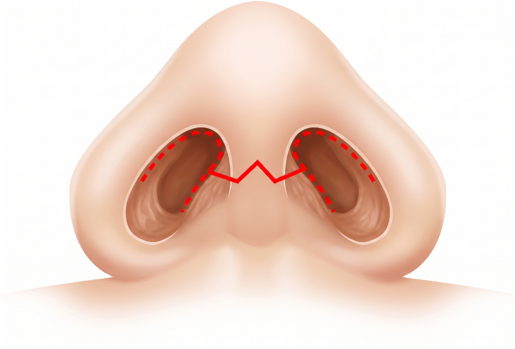福岡の団子鼻治療「鼻尖縮小」は傷跡が目立たない
