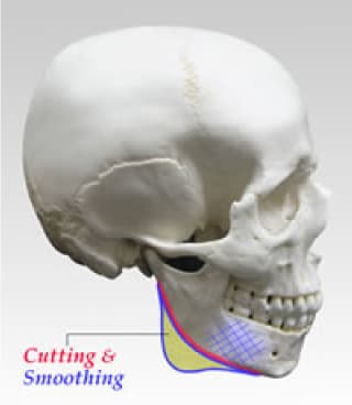 福岡市の下顎骨角形成の施術方法