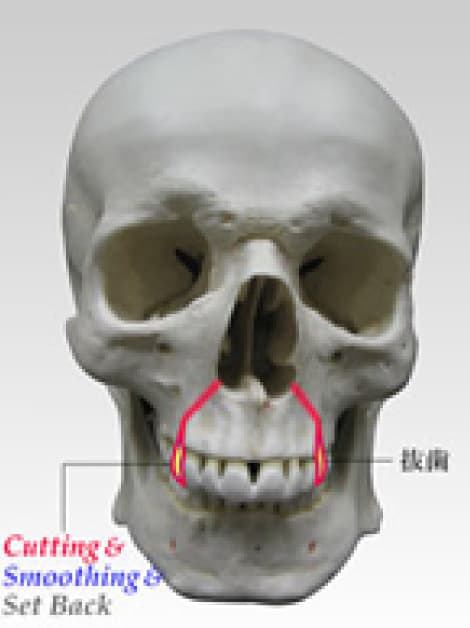 上顎歯槽骨形成