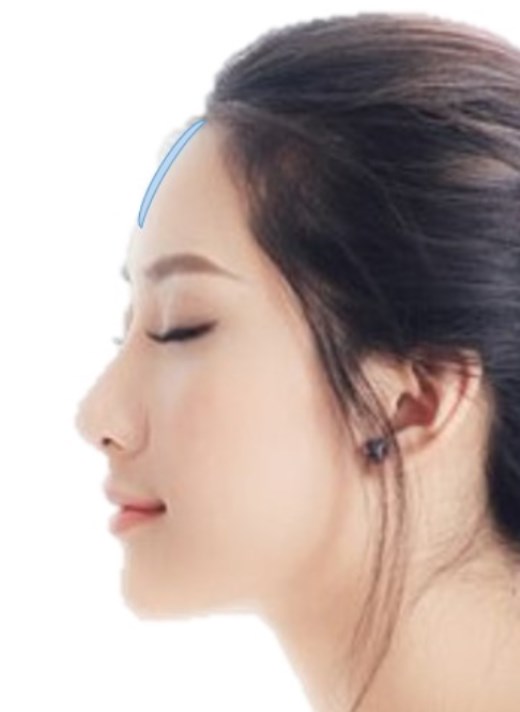 額に丸みを出す場合 鼻・額（おでこ）・顎のヒアルロン酸によるプチ整形。福岡市中央区天神の美容外科 美容クリニック
