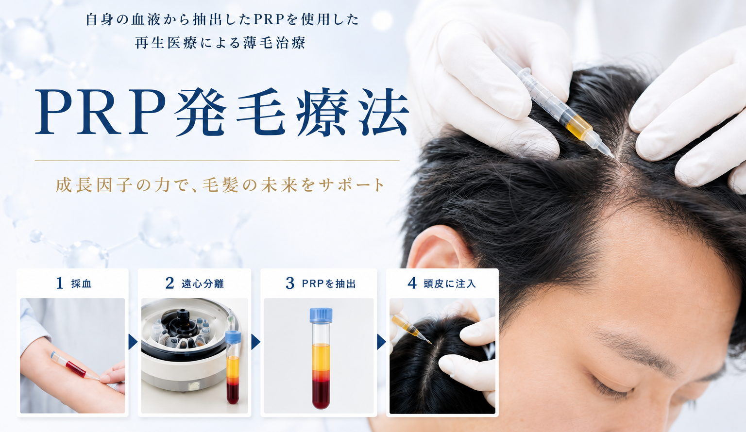 福岡の再生医療による薄毛・AGA治療「PRP発毛治療」