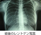 術後のレントゲン写真