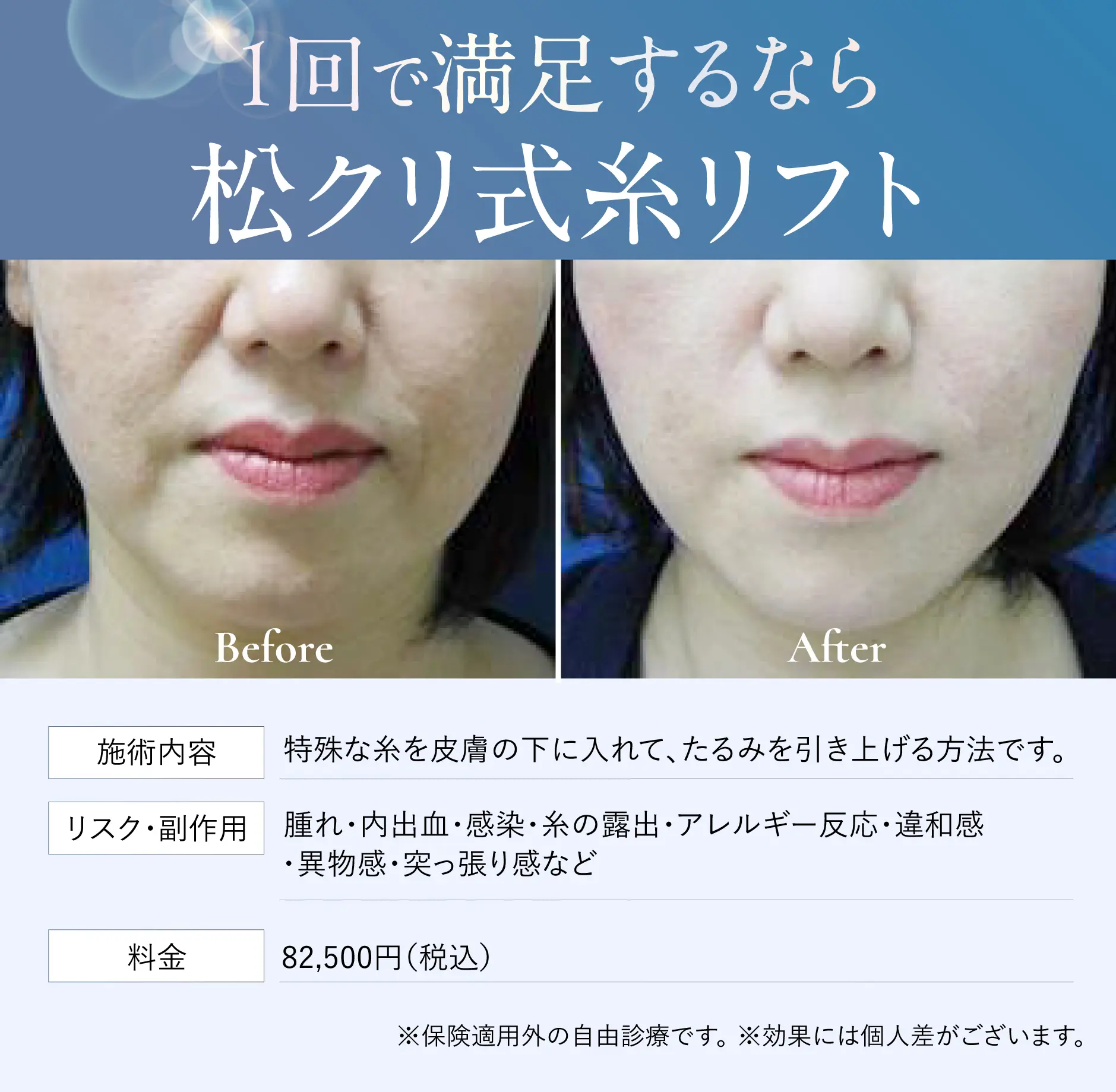1回で満足するなら松クリ式糸リフト Before After