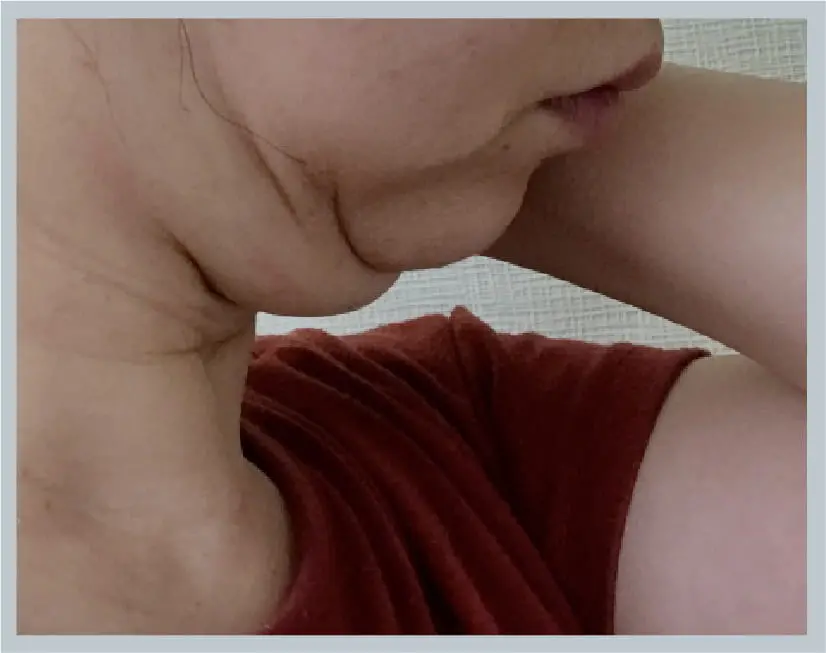 たるみによる二重アゴの画像