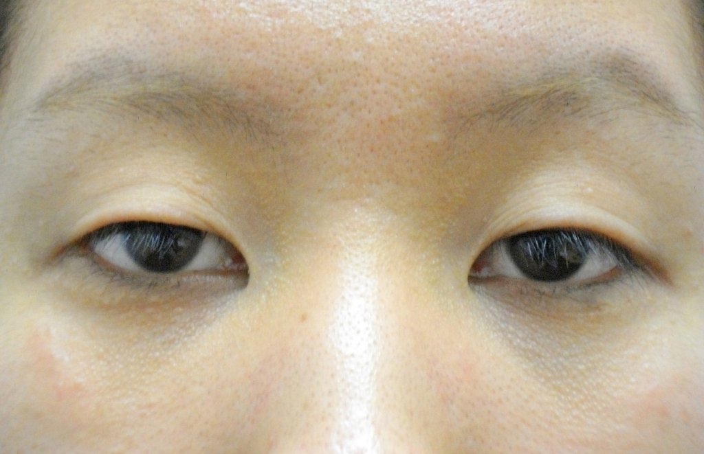 眼瞼下垂修正術⑤・目頭切開術