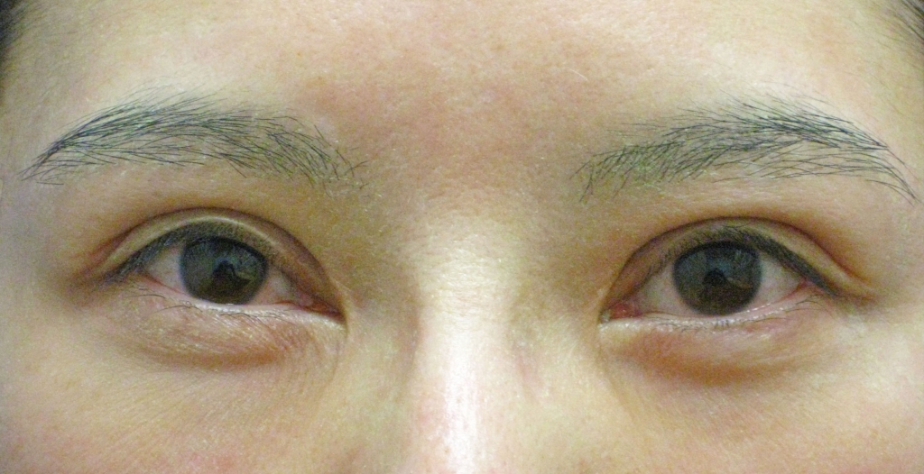 眼瞼下垂修正術⑯・二重幅修正