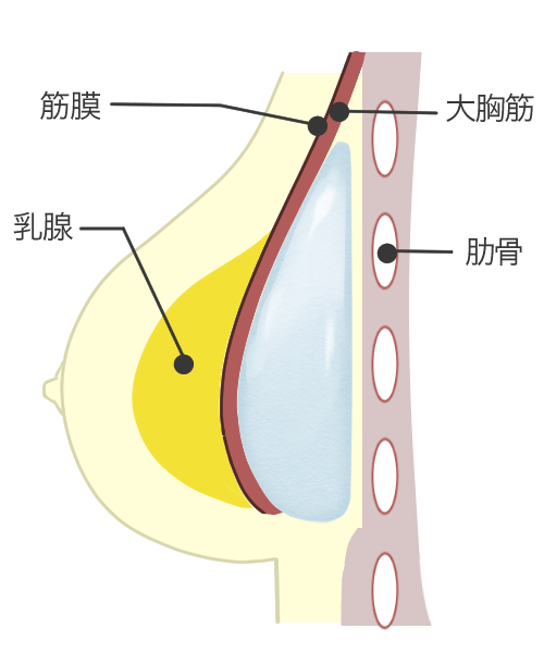 豊胸・バストアップの乳腺下法3