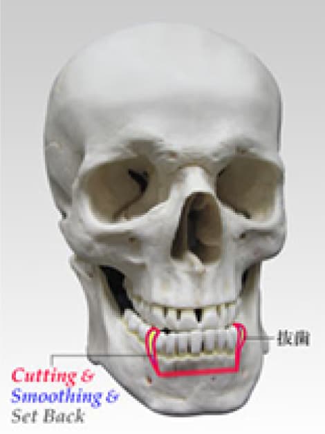 下顎歯槽骨形成