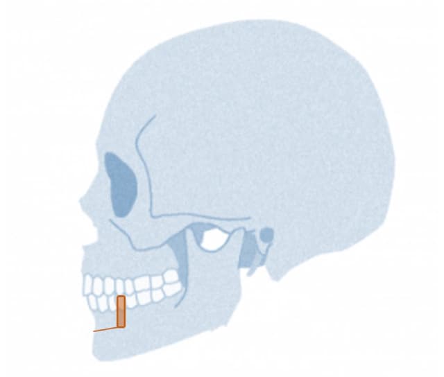 下顎歯槽骨形成 施術方法